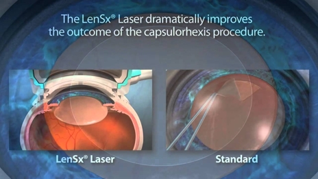 Alcon LenSx Laser System 愛爾康雷視能雷射系統
